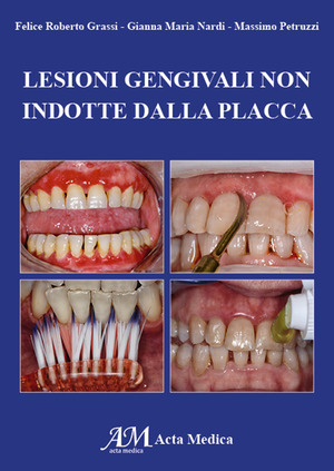 Lesioni gengivali non indotte dalla placca